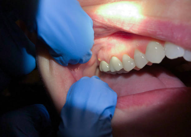 Best Emergency Dentist for Special Needs Patients in South Glens Falls, NY